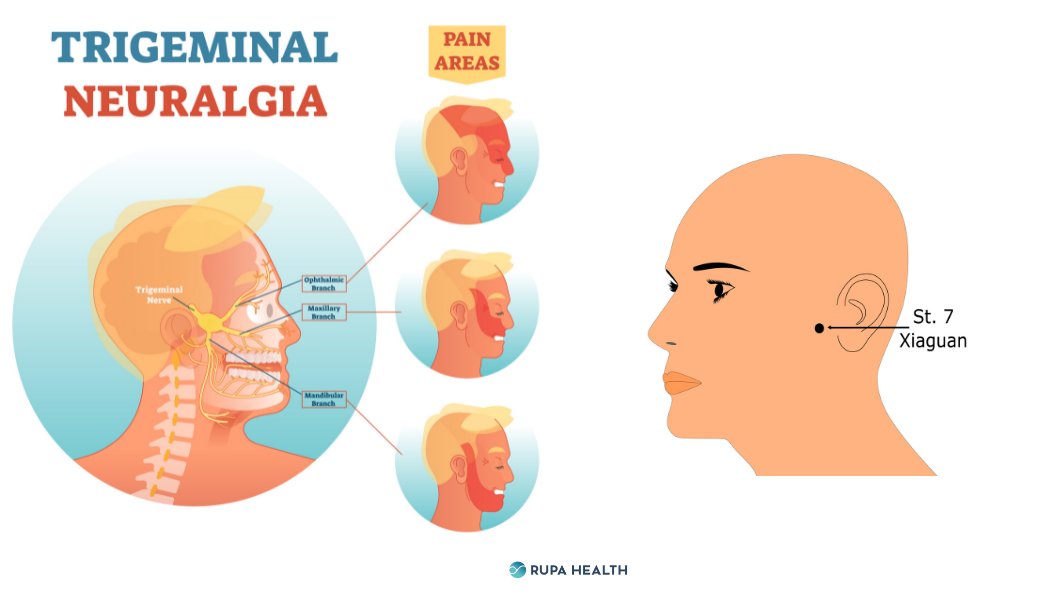 Trigeminal Neuralgia Causes, Triggers, and Treatments